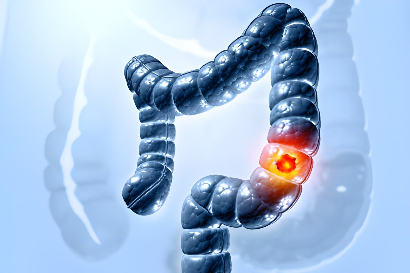 GI Cancer